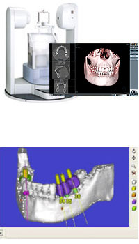 歯科用CT