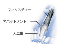 インプラントの構造