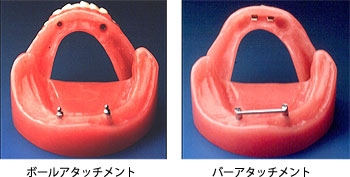 歯を全て失った場合