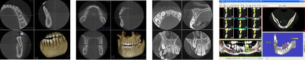 歯科用CT