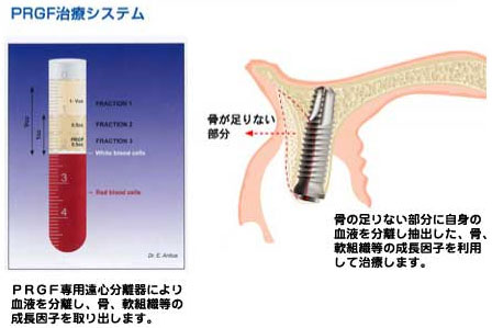 再生歯科医療 PRGF