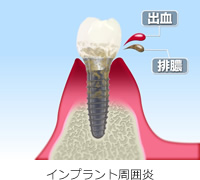 インプラント周囲炎