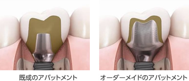 オーダーメイドアバットメントで周囲炎のリスクをなくす