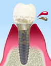 インプラント周囲炎とメインテナンス
