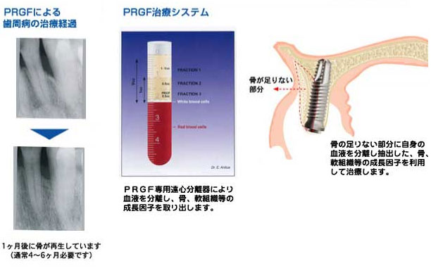 PRGFの治療法について